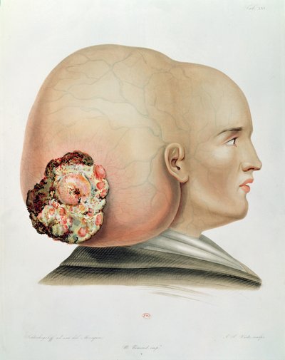 1856年パリのアレクサンドルオベール作「Selecta Praxis Medico-Chirurgica」の硬膜の真菌 作： French School