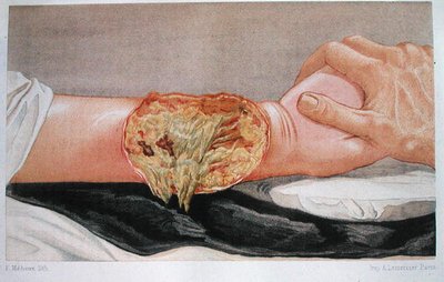 病院の壊疽、Edmund Delorme（1847-1929）の「Traite de Chirurgie de Guerre」より、F. Meheuxが彫刻。 作： French School