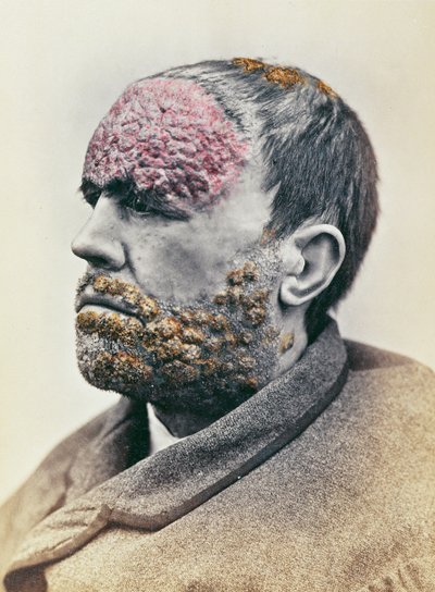 梅毒に苦しんでいる人、クリニークの写真、l-Hopital Saint-Louis、1868年に撮影された写真 作： French School