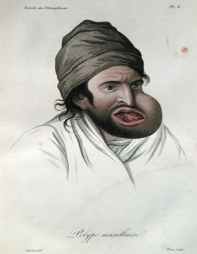 上顎のポリープ、Baron Jean Louis Alibert（1768-1837）の著書より 1817年（彩色彫刻） 作： French School