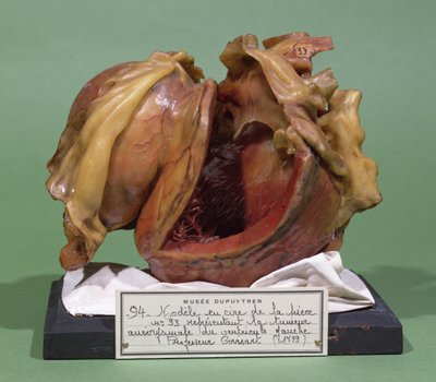左心室の腫瘍のモデル、1799（ワックス） 作： French School