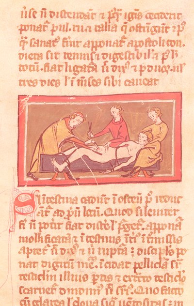 Ms H 89 fol.23手術、Rogier de Salerne著 『Book of Surgery』から 作： French School