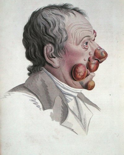 Mycosis Fongoide、Baron Jean Louis Alibert (1768-1837)の著書より 1838年（彩色されたエングレービング） 作： French School