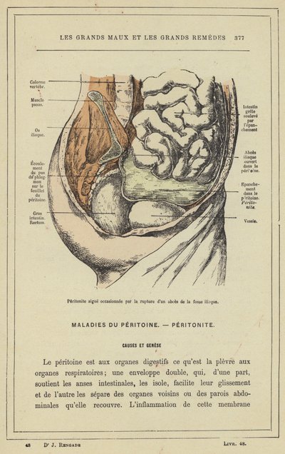 腸骨窩の膿瘍の破裂による急性腹膜炎（カラーリトグラフ 作： French School
