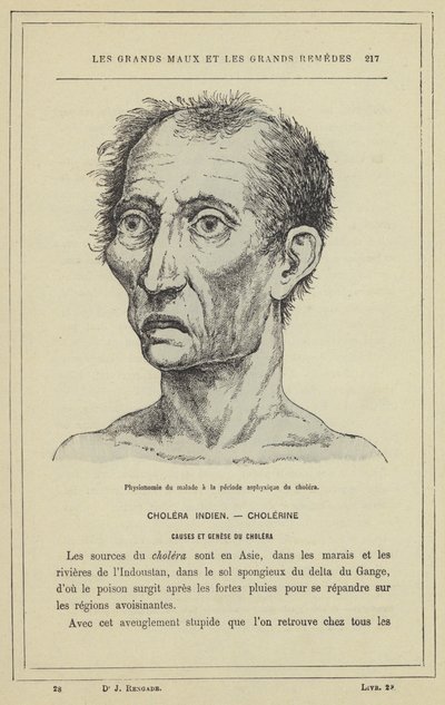 コレラの窒息期における患者の人相（カラーリトグラフ 作： French School