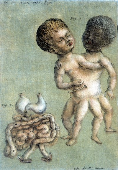 シャムの兄弟（白と黒）を表現した薬皿。トゥーサン（1756年）による「生理、自然史、芸術に関する定期的観察」の挿絵。 作： French School