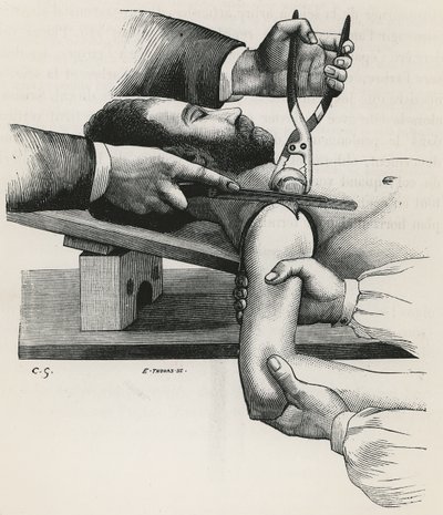 肩の切除（Louis-Hubert Farabeufの「Précis de Manuel Opératoire」より 作： French School