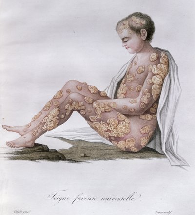 白癬、バロンジャンルイアリベール（1768-1837）1838年の本から 作： French School