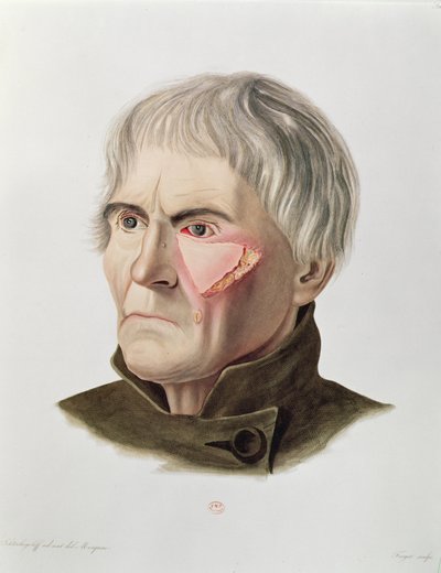 1856年、パリのアレクサンドルオベール作「Selecta Praxis Medico-Chirurgica」による皮膚移植手術 作： French School