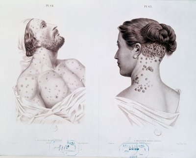医学書c.1850-60からの男性と女性の梅毒の症状 作： French School