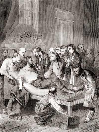 1846年、アメリカの歯科医ウィリアム・トーマス・グリーン・モートンが、外科用麻酔薬として吸入エーテルを使用することを初めて公開した様子（1870年頃に出版された「Les Merveilles de la Science」より 作： French School