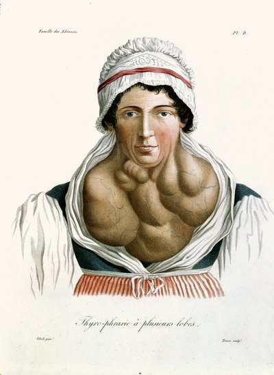 甲状腺疾患、ジャン・ルイ・アリベール男爵（1768-1837）1817年の本から 作： French School