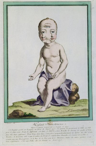 変形した頭を持つ子供、「レエカルトデラネイチャー」、パリ、1775年 作： Genevieve Regnault de Nangis
