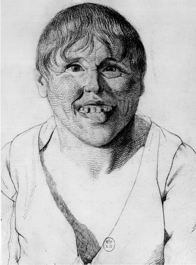 Cretine, - "Etude de la physionomie des alienes "の中で、Gabrielが描いている。 作： Georges Francois Gabriel