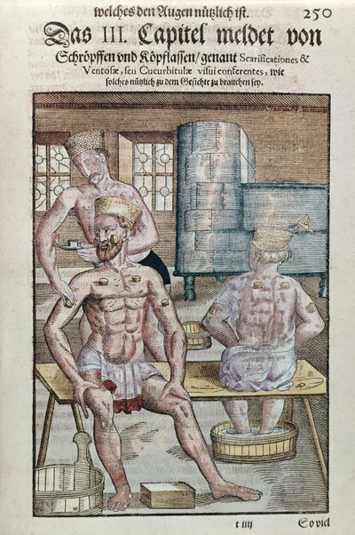 カッピング、1583年にドレスデンで出版されたGeorg Bartisch（1535-1636）によるOphthalmodouleiaから（色木版画） 作： German School