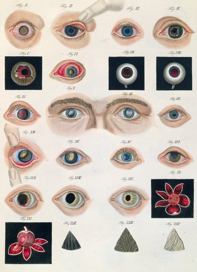 フリードリッヒ・アウグスト・フォン・アンモン（1799-1861）1838による、先天性の眼の異常の説明、病気の臨床的表現および人間の目の盲目な欠陥から 作： German School
