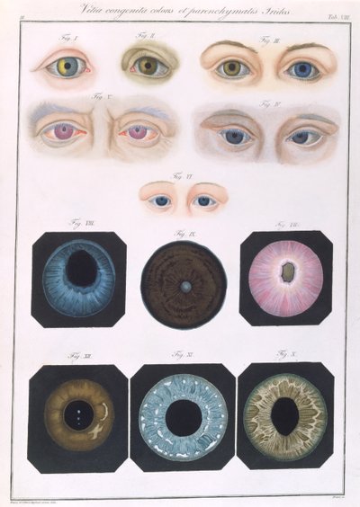 フリードリッヒ・アウグスト・フォン・アンモン（1799-1861）1838による、先天性の眼の異常の説明、病気の臨床的表現および人間の目の盲目な欠陥から 作： German School