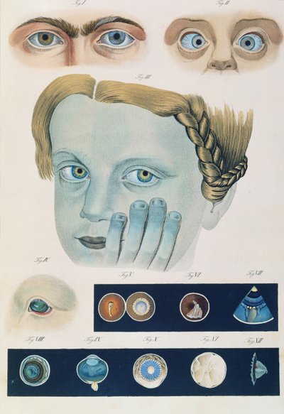 フリードリッヒ・アウグスト・フォン・アンモン（1799-1861）1838による、先天性の眼の異常の説明、疾患の臨床的表現および人間の目の失明の欠陥から 作： German School