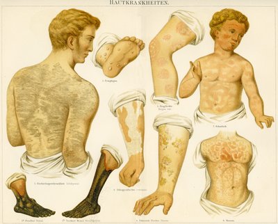皮膚疾患、1890年頃 作： German School