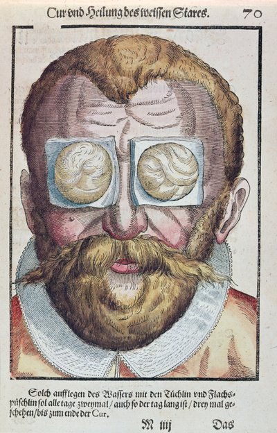 眼の状態の治療、1583年にドレスデンで出版されたGeorg Bartisch（1535-1636）によるOphthalmodouleiaから（カラー木版画） 作： German School