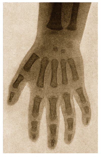 子供の手のX線c.1890 作： German School