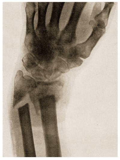骨折した手首のX線c.1890 作： German School