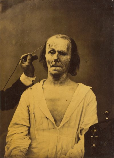 リラックスした顔（左）。 大注目（右） 作： Guillaume Benjamin Amant Duchenne