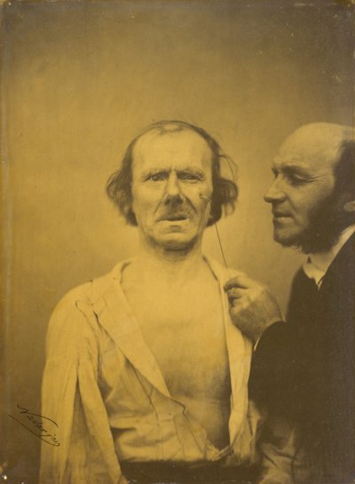 嘆き、同情の涙（左）。 リラックス顔（右） 作： Guillaume Benjamin Amant Duchenne