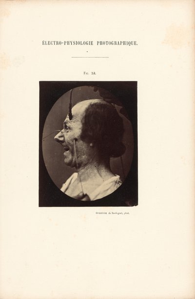 写真電気生理学、図39 作： Guillaume Benjamin Duchenne