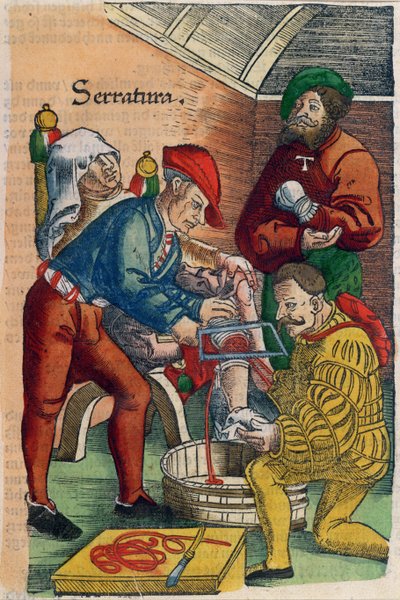 切断、ハンスフォンゲルスドルフの「フェルトブッフデアヴンダルツニー」のイラスト、c.1540（カラー木版画） 作： Hans or Johannes Ulrich Wechtlin