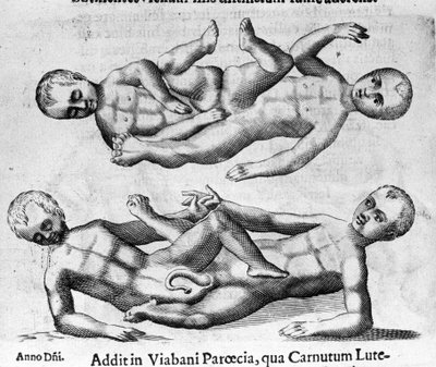さまざまなタイプの人間のモンスター。骨盤でつながったシャムの子供たち。イタリアの科学者Fortunio Liceti(1577-1656)の「De monstrorum natura, causis et differentiis」からの版画。1646 作： Italian School