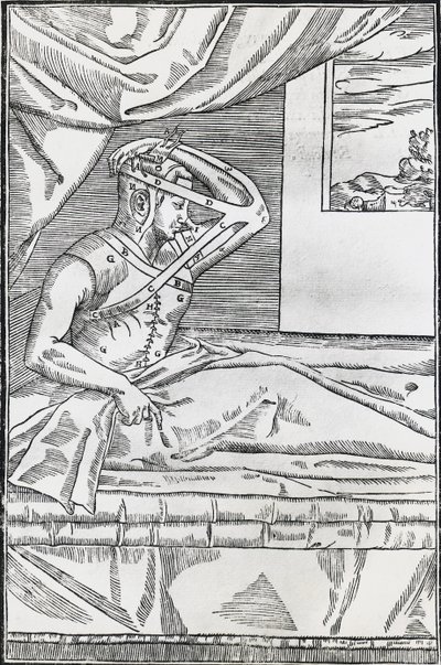 患者の鼻を上腕部の皮膚のフラップに貼り付ける鼻形成術 作： Italian School