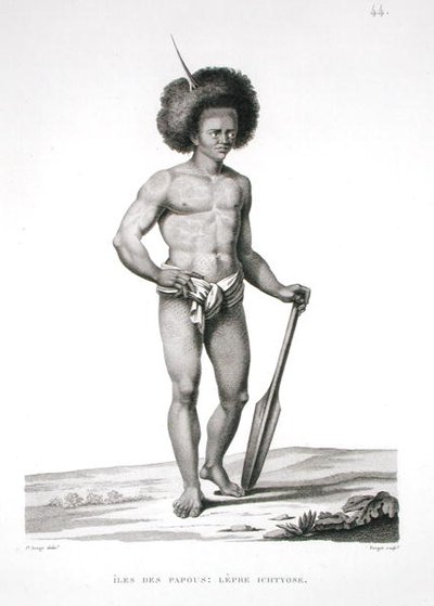 パプア諸島。ルイ・クロード・ドゥソールセス・ド・フレシネ（1779-1842）の「世界旅行（1817-20年）」よりハンセン病患者、フォルジェの彫刻、1822-24年に出版（リトグラフ）。 作： Jacques Etienne Victor (after) Arago