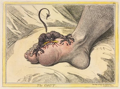 痛風、1799年。 作： James Gillray