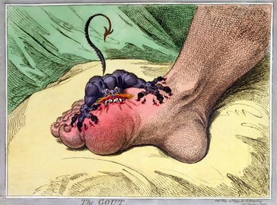 痛風、1799年にハンナハンフリーによって発行された（手塗りの軟地エッチング） 作： James Gillray