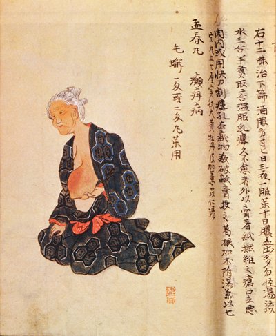 花岡誠秀（1760-1836）が1804年に全身麻酔下で行った乳がんの最初の外科的治療 作： Japanese School