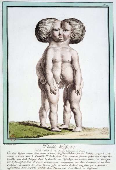 シャムの子供たち - レグノーの「自然の逸脱」にて 作： Jean Baptiste Regnault