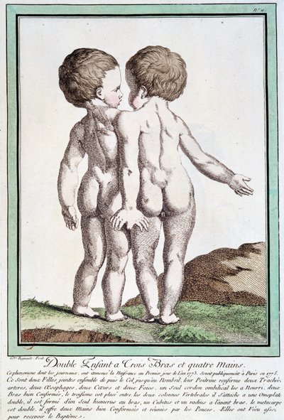 シャムの子供たち - レグノーの「自然の逸脱」にて 作： Jean Baptiste Regnault