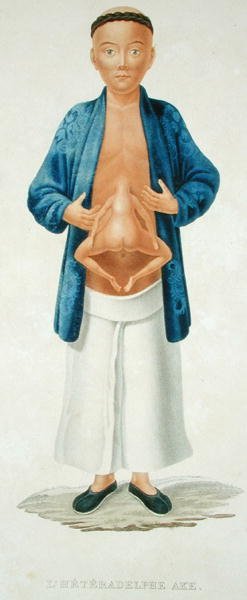 腹部に未発達の結合双生児を付けた中国人男性、フランスの旅行記の挿絵、M.ルグランの刻印（カラーエングレーヴィング） 作： Jean Gabriel (after) Pretre