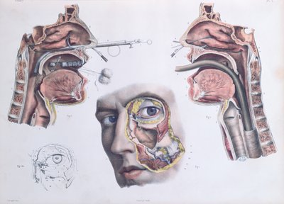 鼻の手術、ジャンバティストマルクブールジュリー（1797-1849）1866-67による「Traite Complet de l&39;Anatomie de l&39;Homme」のプレート 作： Nicolas Henri Jacob