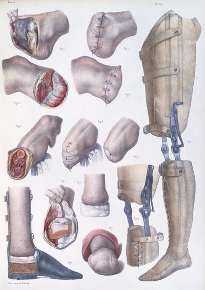 切断および補綴、ジャン・バティスト・マルク・ブールジェリー（1797-1849）1866-67による「Traite Complet de l&39;Anatomie de l&39;Homme」のプレート 作： Nicolas Henri Jacob