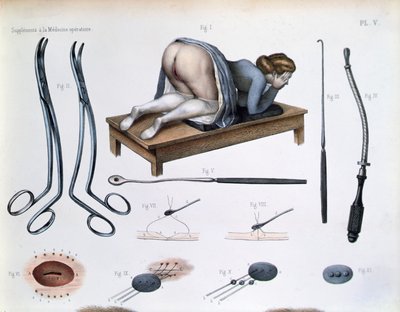 膀胱膣瘻の手術、Jean-Baptiste Marc Bourgery (1797-1849) 1866-67年の「Traite Complet de l