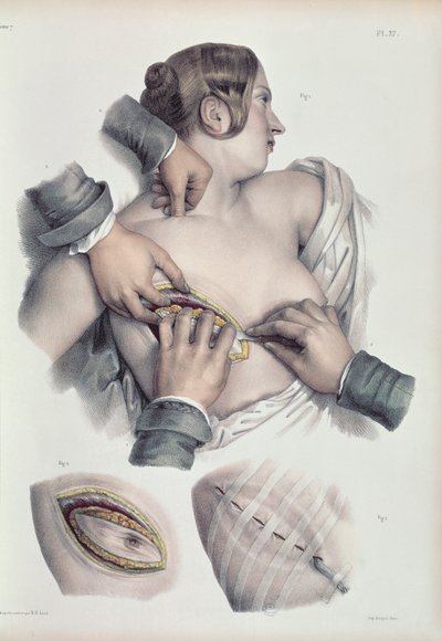 Jean-Baptiste Marc Bourgery（1797-1849）1866-67による &39;Traite Complet de l&39;Anatomie de l&39;Homme&39;からの癌性腫瘍の手術 作： Nicolas Henri Jacob