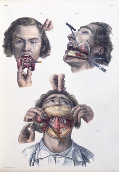 下顎の手術、ジャン・バティストマルクブールジェリー（1797〜1849）、1866〜67年の「Traite Complet de l&39;Anatomie de l&39;Homme」のプレート 作： Nicolas Henri Jacob