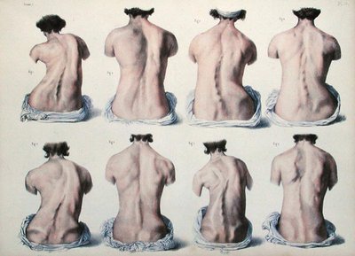 脊椎の変形、Jean-Baptiste Marc Bourgery (1797-1849) 1866-67年の「Traite Complet de l
