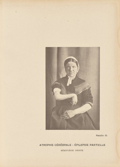 脳萎縮部分てんかん 右片麻痺 作： Paul Marie Léon Regnard