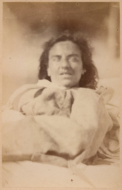 ヒステリーてんかん、幻覚、皮肉、プレートXXXII、「Iconographie Photographique de La Salpetriere」、ボーンビルとP.レニャール、パリ、1876年（アルブメンプリント） 作： Paul Regnard