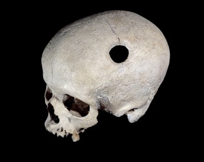 トレパネーション痕のある先史時代の頭蓋骨（国立考古学博物館蔵 作： Prehistoric Prehistoric