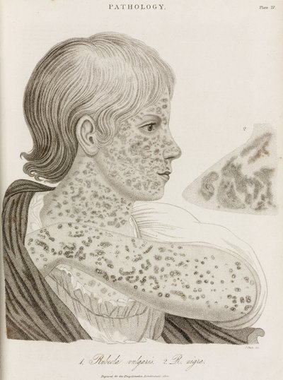 病気, 麻疹 2種類の麻疹 作： John Pardon