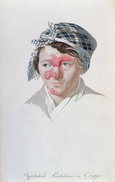 ジャンルイアリベール男爵（1768-1837）1838年の書物からの、梅毒のクラスター膿疱 作： Salvadore Tresca